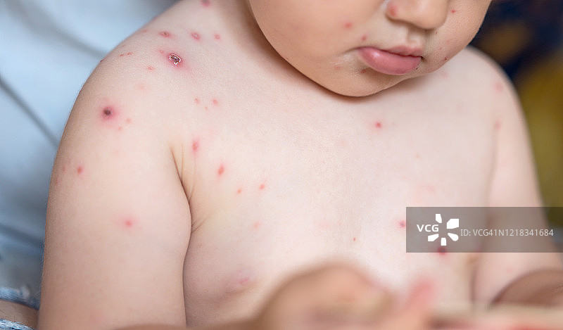 感染带状疱疹病毒的小女孩图片素材