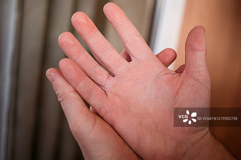因疫情期间酒精洗手而干燥脱皮的手部特写图片素材