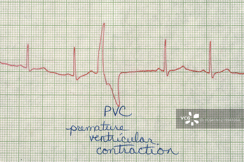 心电图中早搏现象图片素材