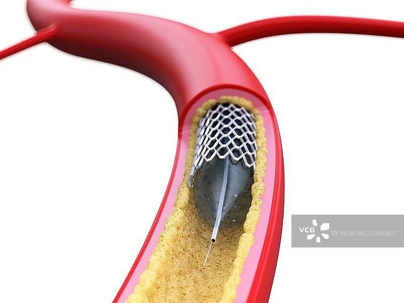 动脉内的支架，图示图片素材