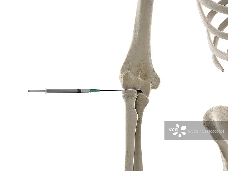 肘部注射，图示图片素材
