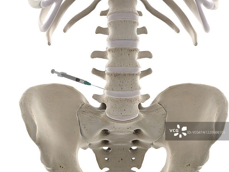 腰椎注射插图图片素材