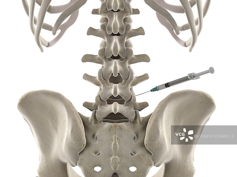 腰椎注射插图图片素材