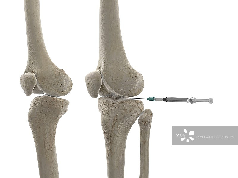 膝关节注射插画图片素材