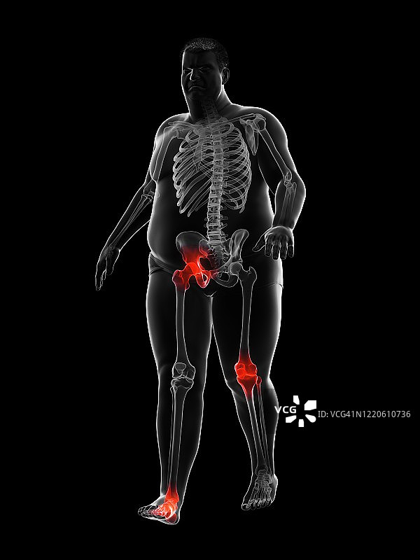 肥胖跑步者疼痛的关节，图示图片素材