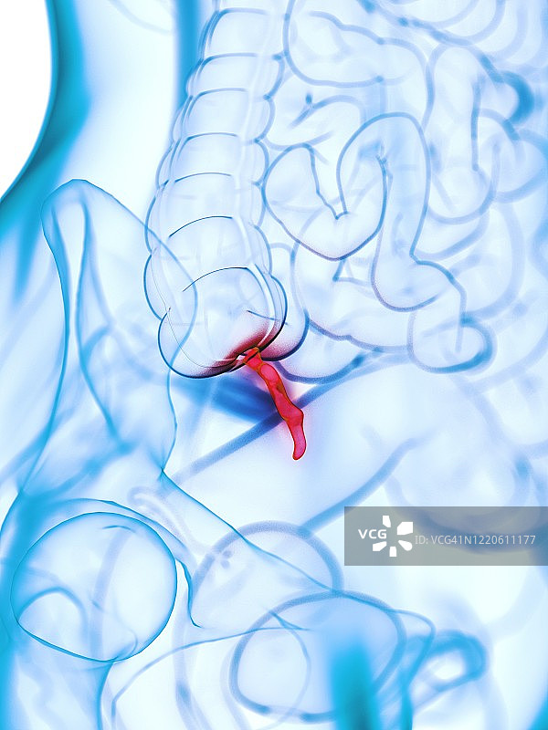 发炎的阑尾插图图片素材