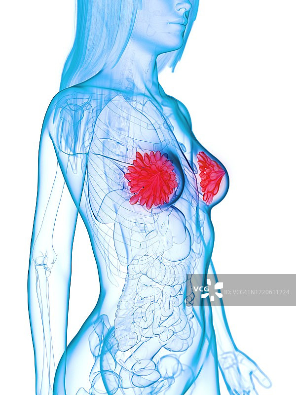患病乳腺插图图片素材