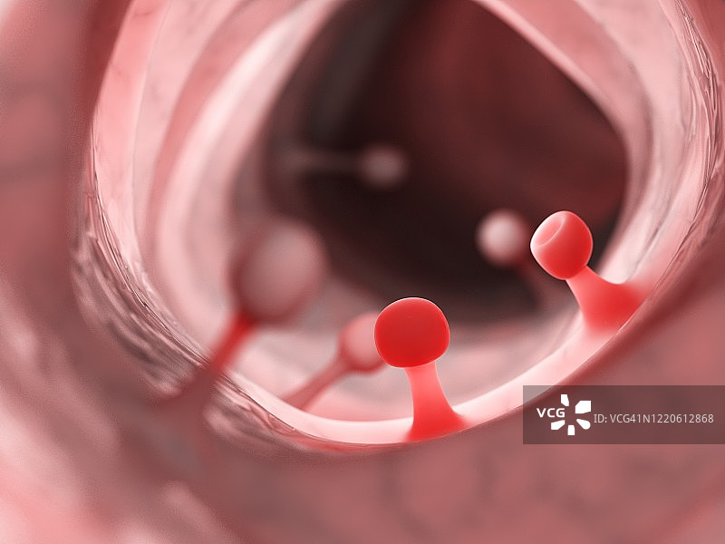 结肠息肉插图图片素材