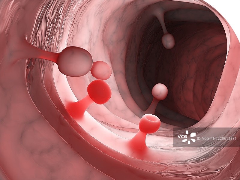 结肠息肉插图图片素材