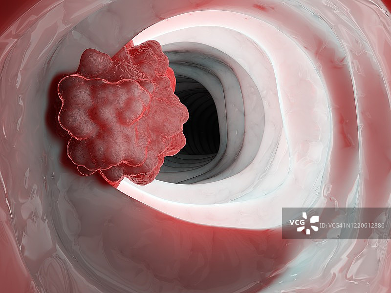结肠肿瘤图图片素材