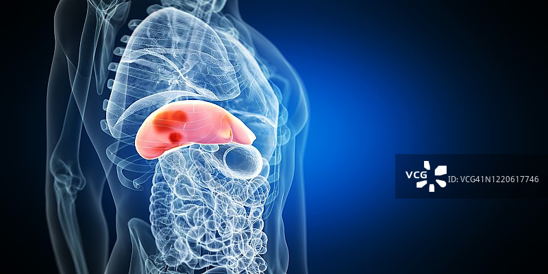 肝脏肿瘤，图示图片素材