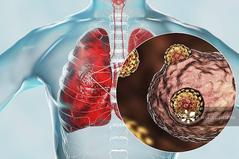 肺部冠状病毒概念图图片素材
