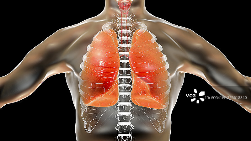 肺炎插图图片素材