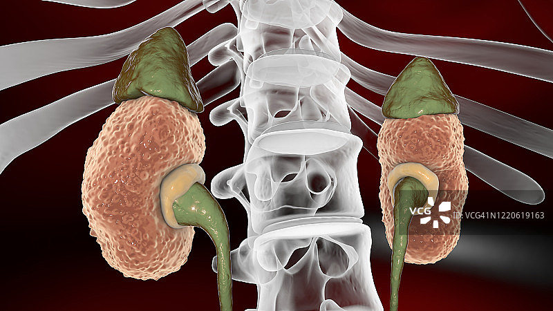慢性肾脏疾病插图图片素材