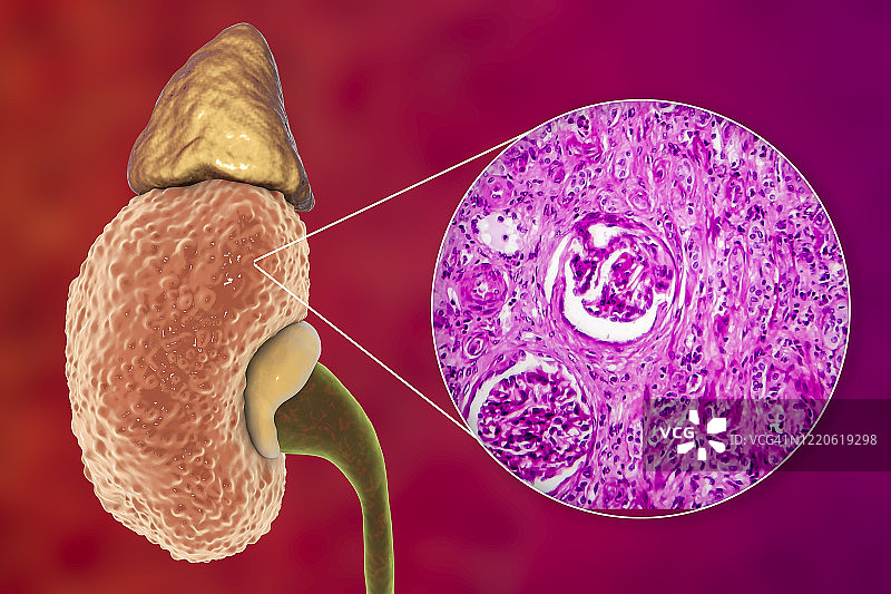 慢性肾脏病，图示和光学显微照片图片素材