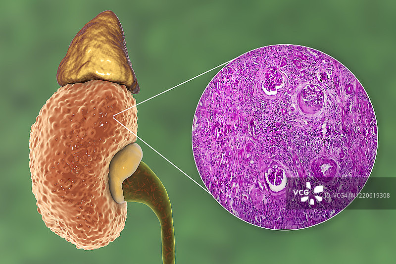 慢性肾脏病，图示和光学显微照片图片素材