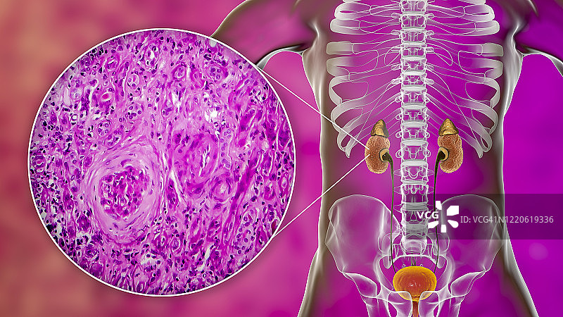 慢性肾脏病，图示和光学显微照片图片素材