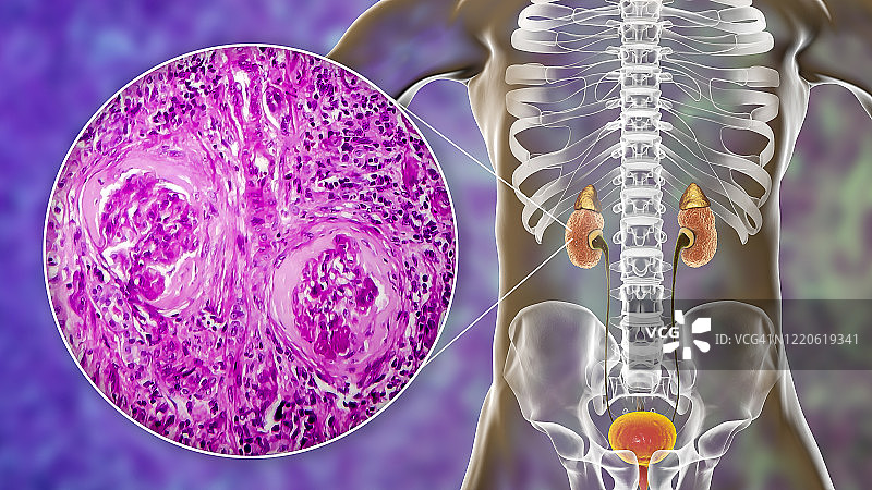 慢性肾脏病，图示和光学显微照片图片素材