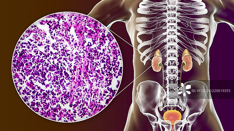 慢性肾脏病，图示和光学显微照片图片素材