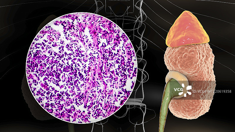 慢性肾脏病，图示和光学显微照片图片素材