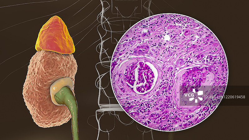 慢性肾脏病，图示和光学显微照片图片素材