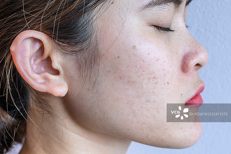 面部有各种皮肤问题（如痤疮、粉刺、毛孔和黄褐斑等）的女性面部特写侧视图图片素材