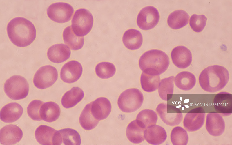 恶性贫血：异常的血涂片显示异常大的（大红细胞）红细胞，维生素B-12缺乏，400倍图片素材