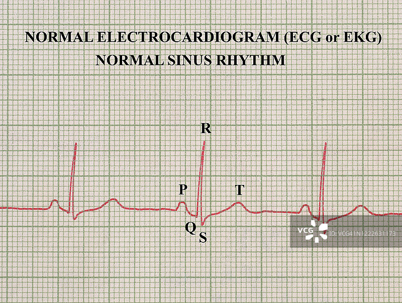 正常心电图（ECG或EKG），正常窦性心律图片素材