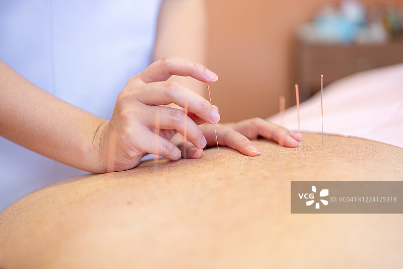 中医针灸疗法：医生用针灸缓解背部疼痛图片素材
