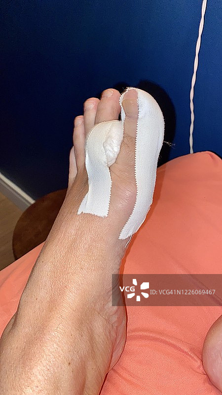 瘀伤的脚-拇囊炎图片素材