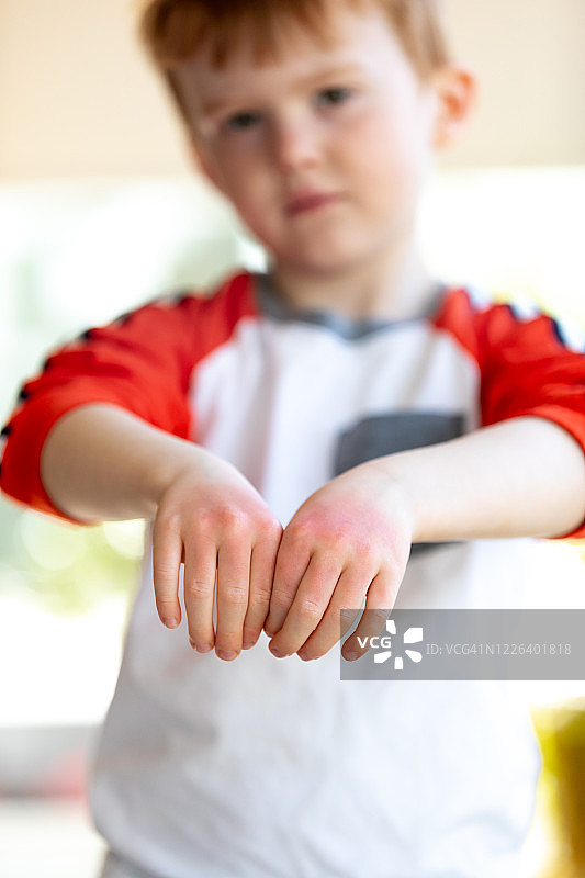晒伤儿童的红肿干燥双手图片素材