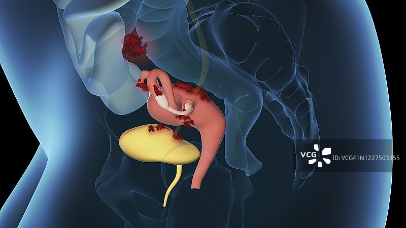 子宫内膜异位症3D图图片素材