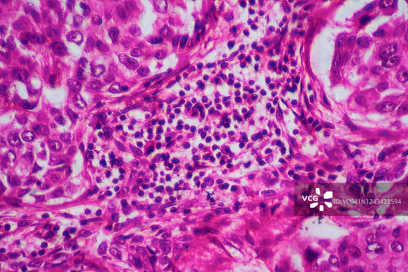 人淋巴结癌细胞图片素材