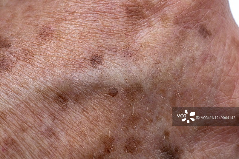 老年皮肤上的老年斑图片素材