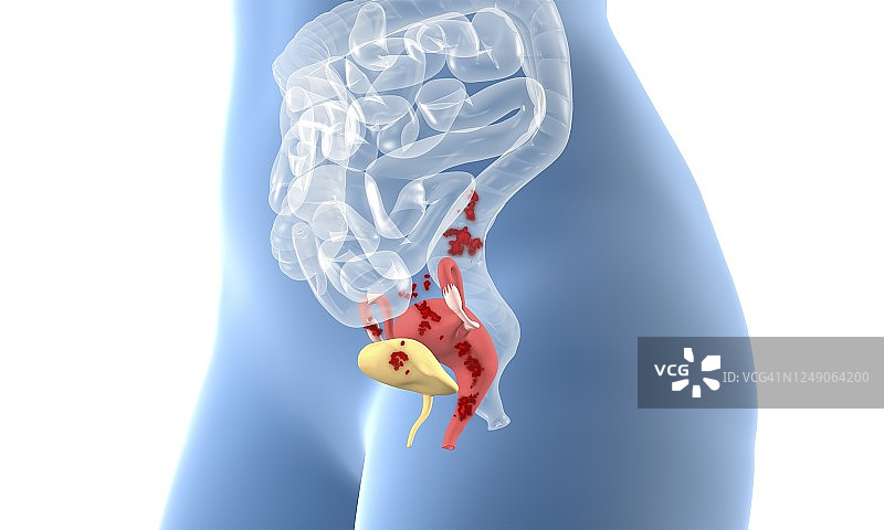 子宫内膜异位症3D图图片素材