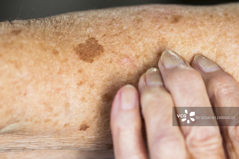 老年皮肤上的肝斑图片素材