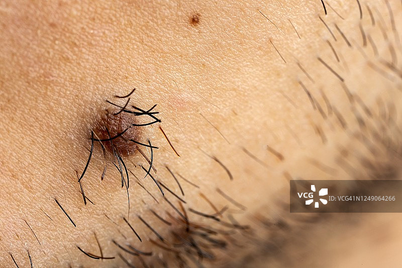 男人脸上的痣图片素材