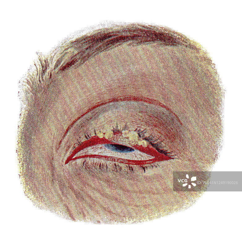 古版画：眼部感染和疾病图片素材