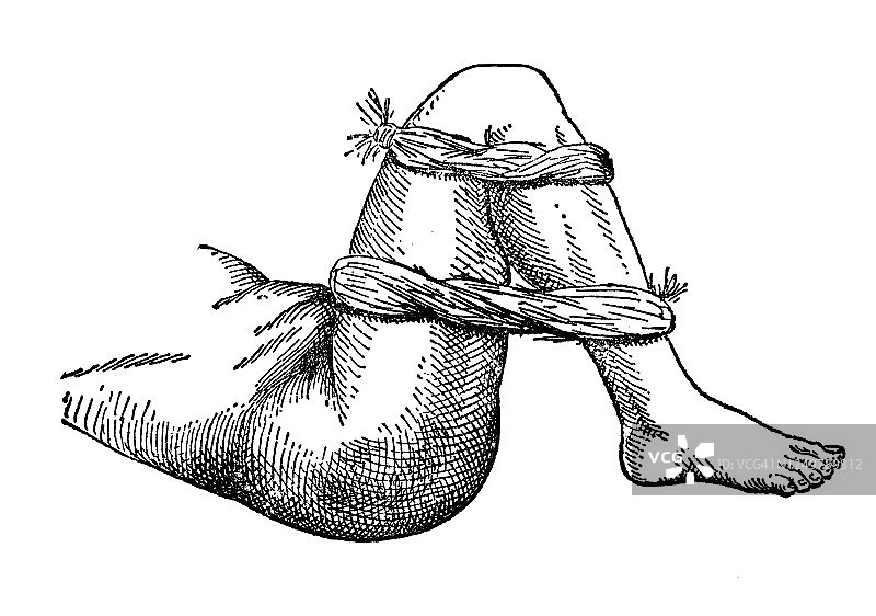 切割腘动脉时的急救古老雕刻插图图片素材