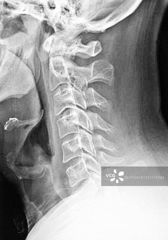 颈部正位X光片图片素材