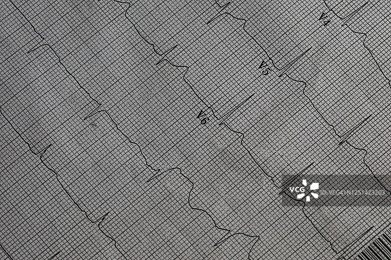 病人显示心脏活动的心电图图片素材