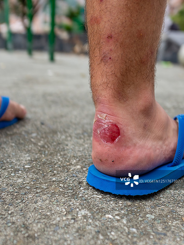 白人男子的脚，穿着蓝色凉鞋，脚踝擦伤，腿被蚊子叮咬图片素材
