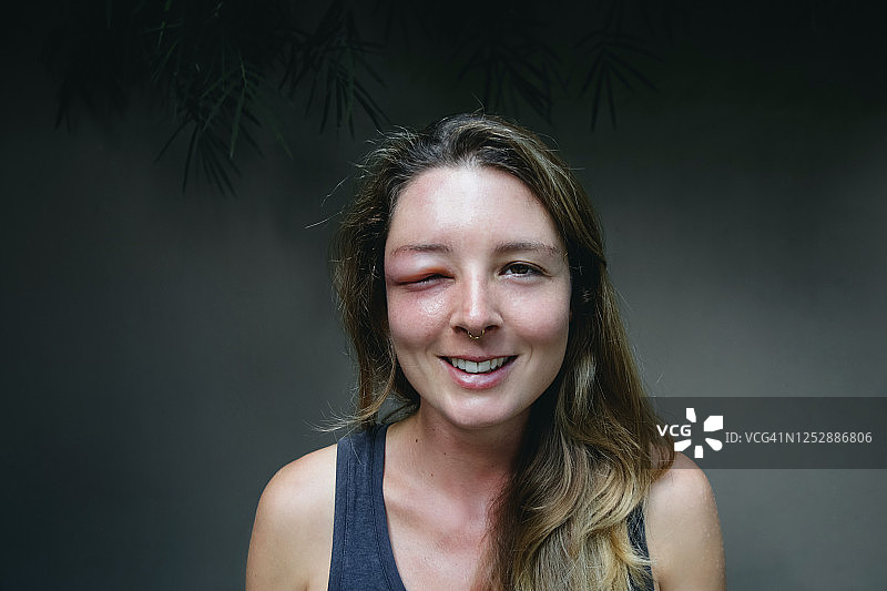 年轻白人女性被黄蜂蜇伤，眼睛肿胀，出现过敏反应。图片素材