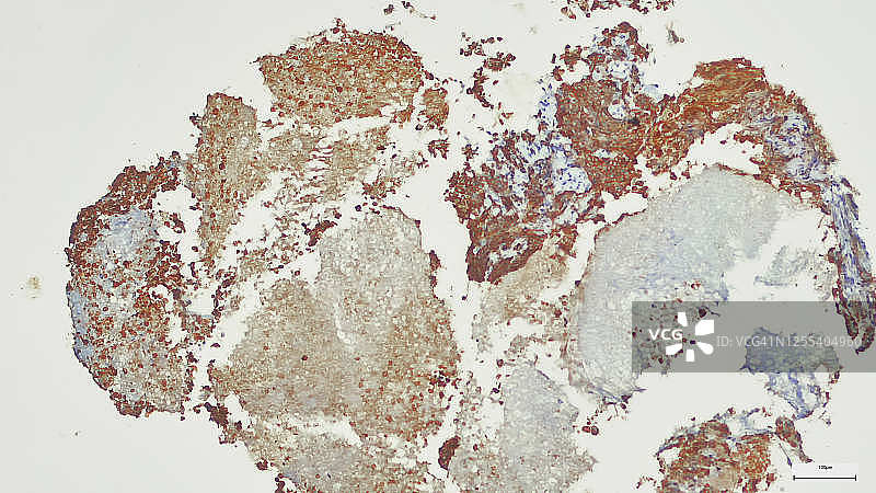 脑癌新生儿筛查：导管原位癌雌激素受体免疫组化染色阳性（经认证的外科病理医生拍摄并上传）图片素材