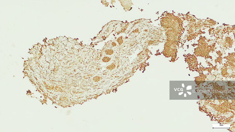 脑癌新生儿筛查：导管原位癌雌激素受体免疫组化染色阳性（经认证的外科病理医生拍摄并上传）图片素材