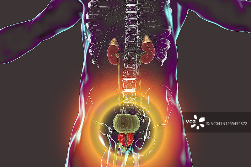 良性前列腺增生插图图片素材