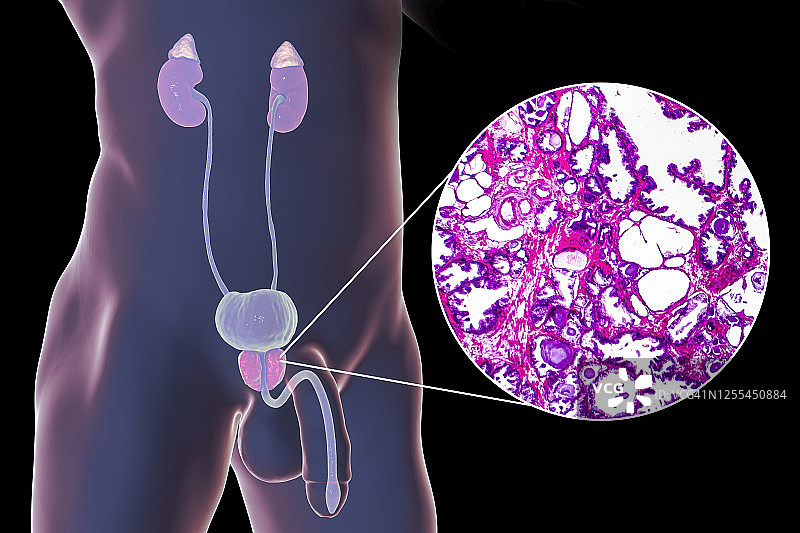良性前列腺增生插图和显微照片图片素材