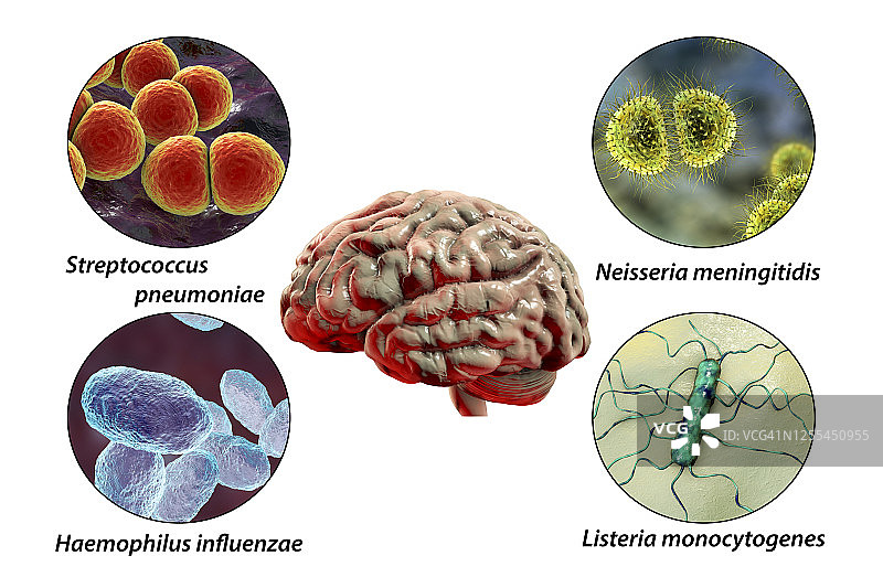 细菌性脑膜炎病因图示图片素材