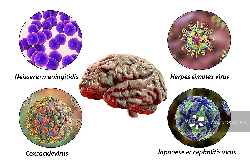 脑部感染插图图片素材