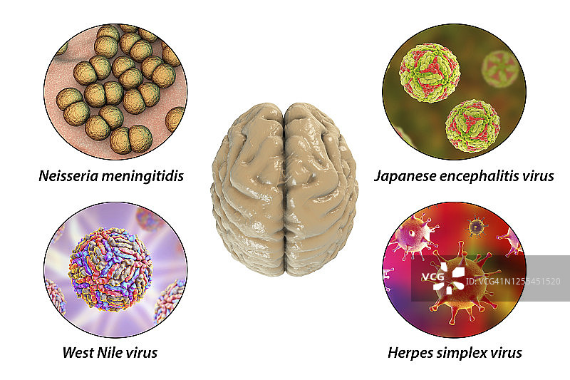 脑部感染插图图片素材